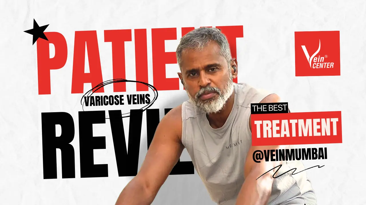 varicose veins review by sakthikumar mumbai