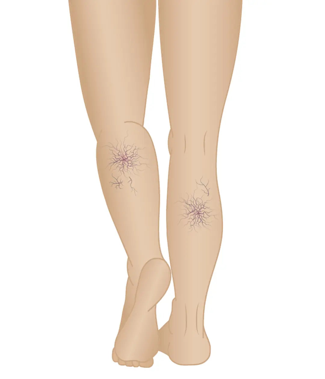 stages of varicose veins phase 2 spider veins.webp
