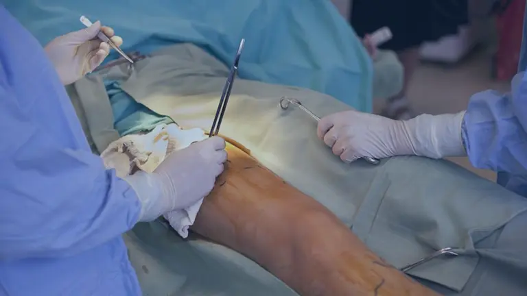 Varicose Veins Treatment vein stripping the vein center.webp