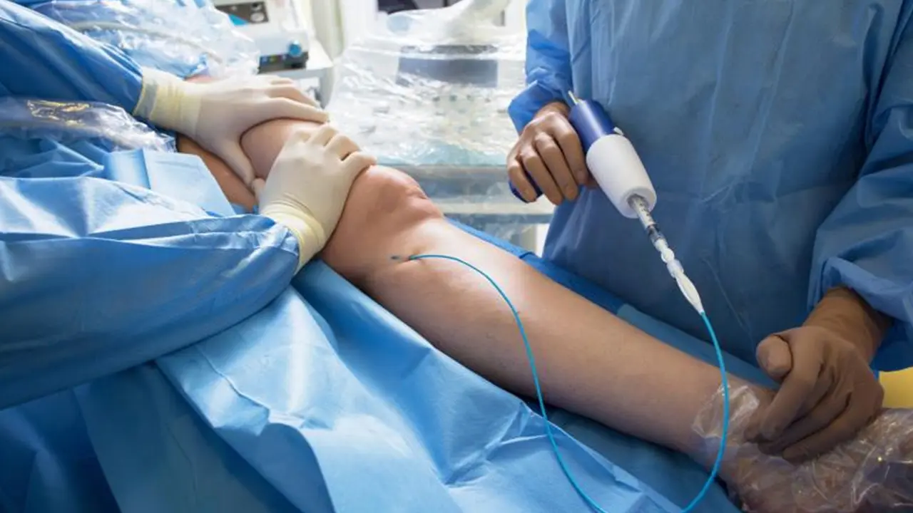 Varicose Veins Treatment venaseal treatment adhesive treatment procedure the vein center mumbai.webp